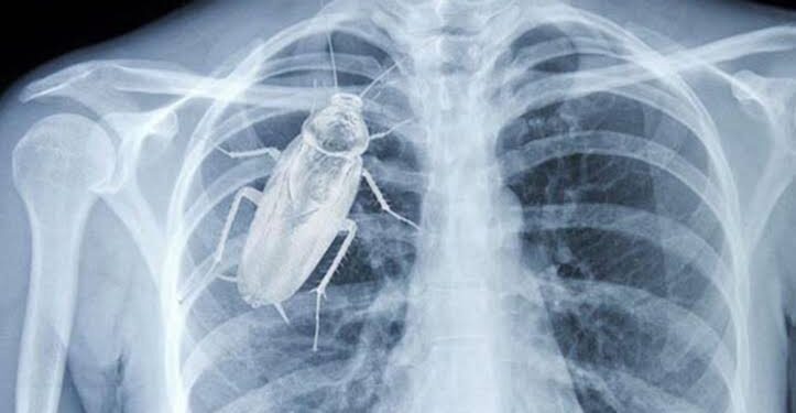 Fact check on cockroach in human chest circulating social media platforms (VIDEO)