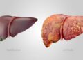 9 Common signs of Liver Damage You Shouldn’t Ignore