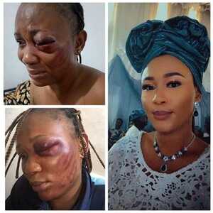 Adejumoke loses eye